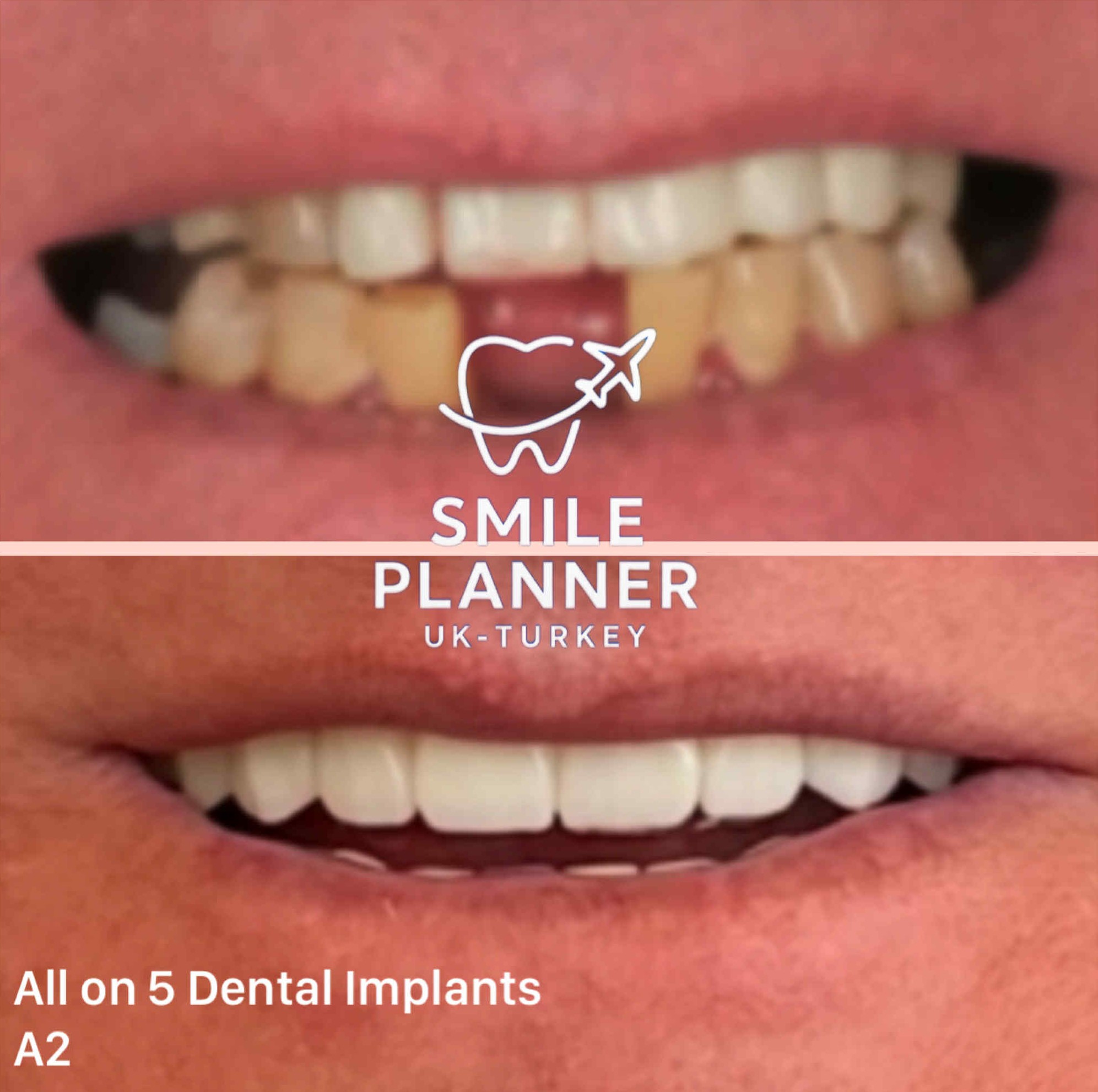 UK male patient smile transformation all-on-5 in Turkey